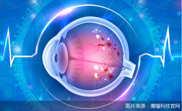图片来源：鹰瞳科技官网